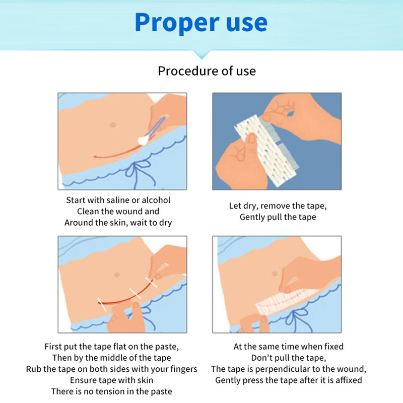 5 Strips Wound Skin Closure St - Medical Label 评论和价格